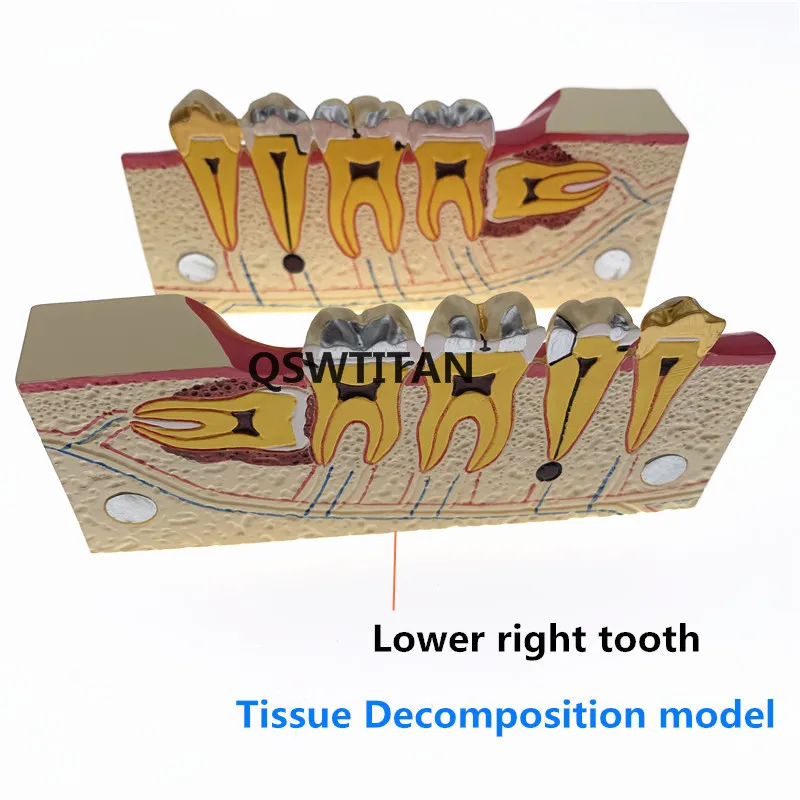 Модель поперечного сечения моляра при заболеваниях зубов Модель для изучения анатомии зубов